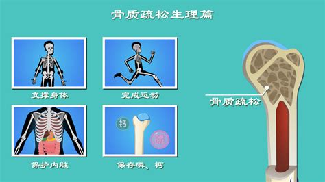 骨质疏松症状会导致腰痛吗