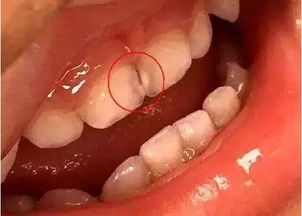 标题预防牙齿出现小黑点和补牙时机的建议