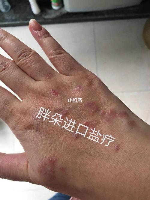 专治牛皮皮癣偏方