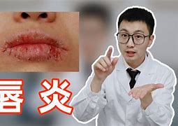 唇炎的症状有哪些挂什么科室