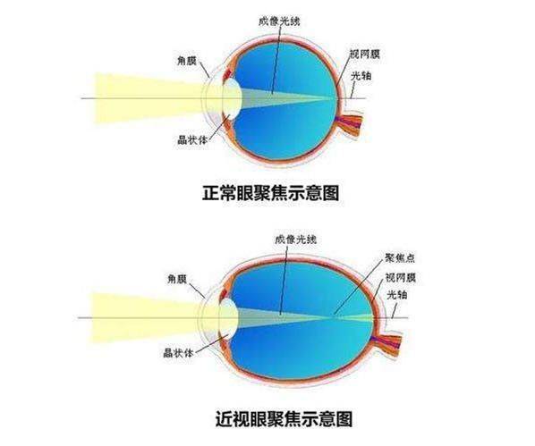 散光的症状和表现图片