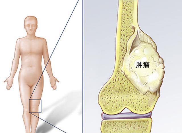 骨癌的前兆与症状

PPT目录
1.**引言**
2.**骨癌概述**
3.**骨癌的常见前兆**
4.**骨癌的典型症状**
5.**诊断方法**
6.**预防与早期发现**
7.**结论**
8.**问答环节**

对应的