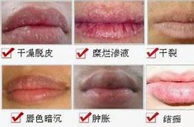唇炎的症状有哪些用什么药