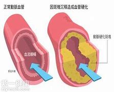 胆固醇升高的症状