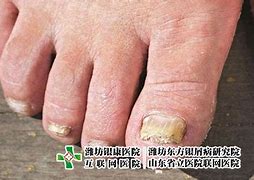 治疗灰指甲的偏方最有效