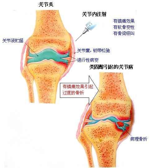 课程评价关于骨性关节炎的症状