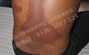 专治牛皮皮癣偏方中药