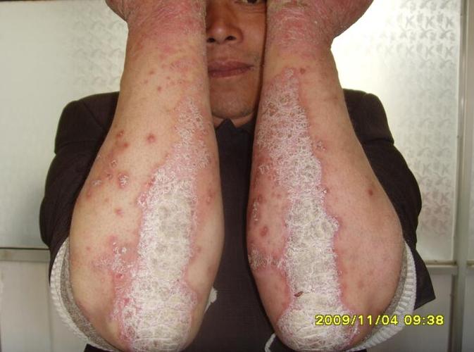 上海治疗牛皮病癣的医院